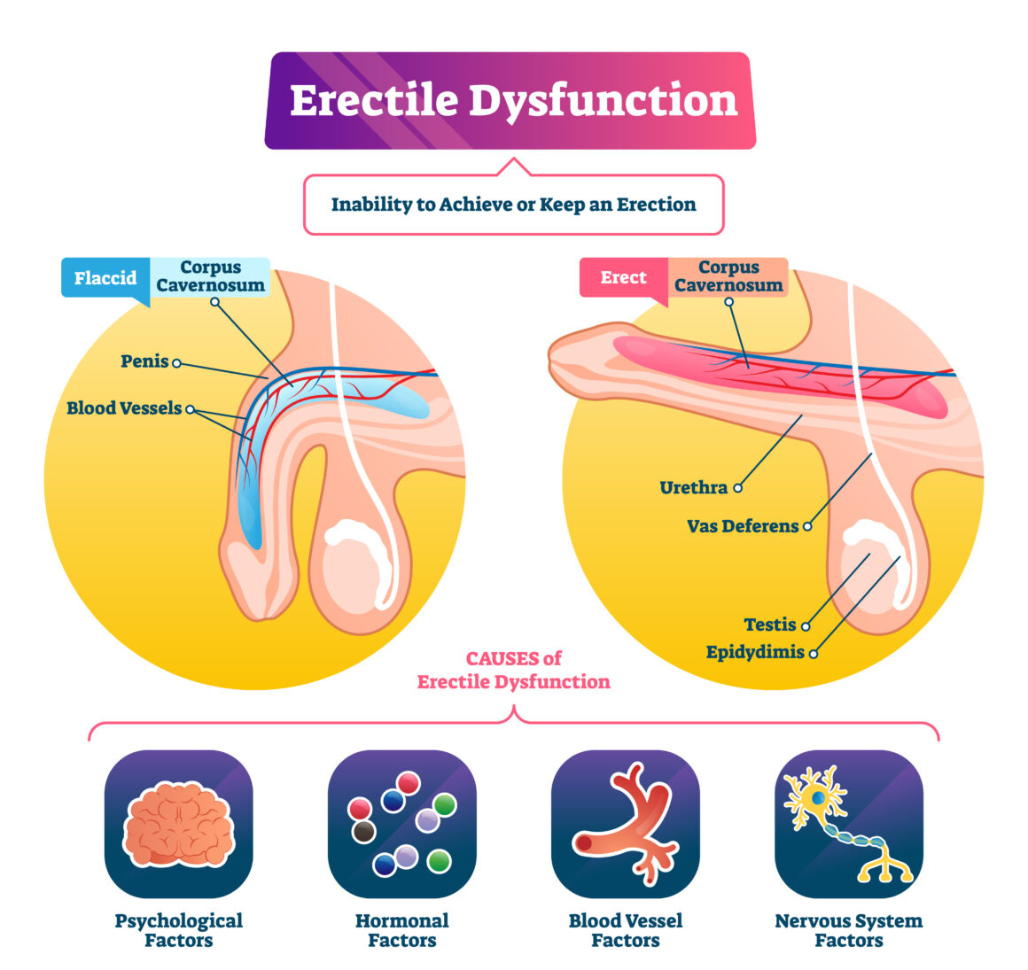 Erectile Dysfunction Diagram