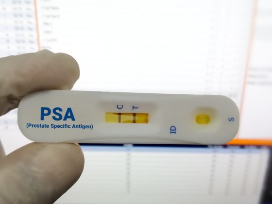 Rapid diagnostic test for PSA or Prostate Specific Antigen